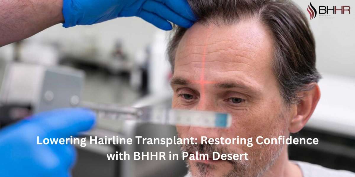 Lowering Hairline Transplant: Restoring Confidence with BHHR in Palm Desert